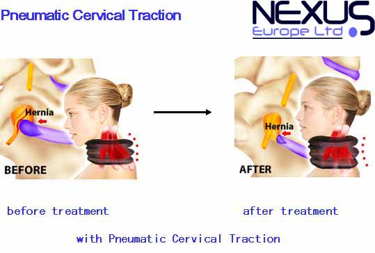 PNEUMATIC NECK SUPPORT, COLLAR & AIR BRACE. Support for NECK, SHOULDERS & BACK